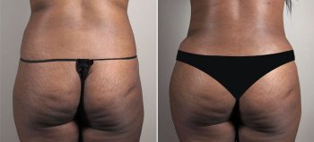 Parker Tummy Tuck Patient 57