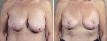 Breast Lift with Auto-Augmentation Patient 6