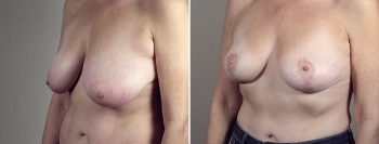 Breast Lift with Auto-Augmentation Patient 6