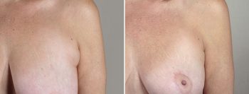 Breast Lift with Auto-Augmentation Patient 6
