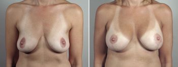 Breast Lift with Implants Patient 50