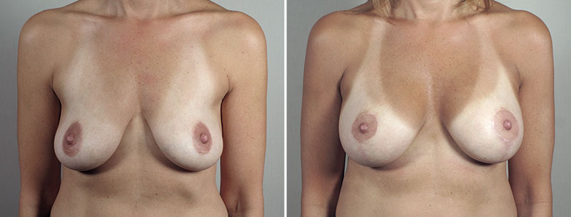 Breast Lift with Implants Patient 50