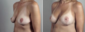 Breast Lift with Implants Patient 50