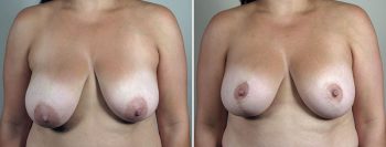 Breast Lift with Augmentation 51