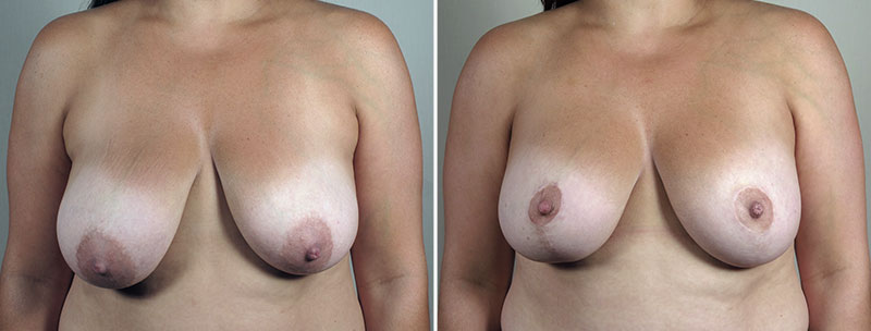 Breast Lift with Augmentation 51