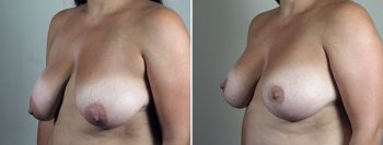 Breast Lift with Augmentation 51