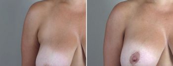 Breast Lift with Augmentation 51