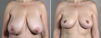Breast Reduction with Lift 4