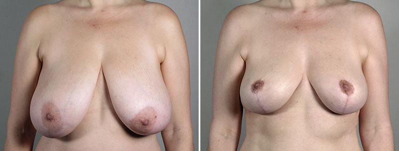 Breast Reduction with Lift 4