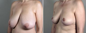 Breast Reduction with Lift 4