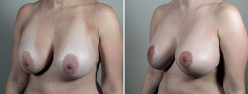 Removal & Replacement of Implants Patient 38