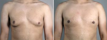 Gynecomastia Reduction Patient 63