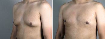 Gynecomastia Reduction Patient 63