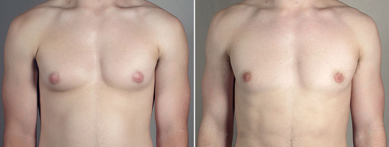 Gynecomastia Reduction Patient 64