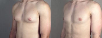 Gynecomastia Reduction Patient 64