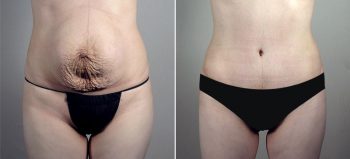 Parker Tummy Tuck Patient 60