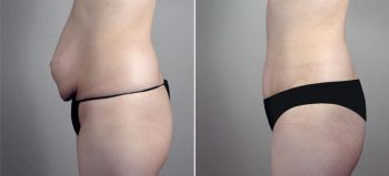 Parker Tummy Tuck Patient 60