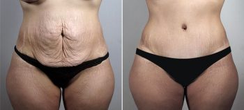 Parker Tummy Tuck Patient 61