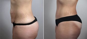 Parker Tummy Tuck Patient 61