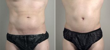 Parker Tummy Tuck Patient 62