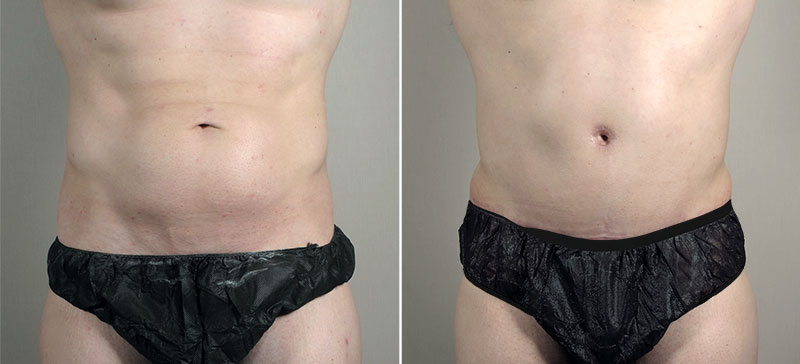 Parker Tummy Tuck Patient 62