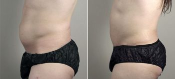 Parker Tummy Tuck Patient 62