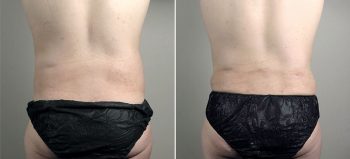 Parker Tummy Tuck Patient 62