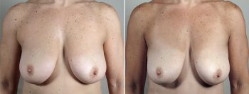 Axillary Breast Liposuction