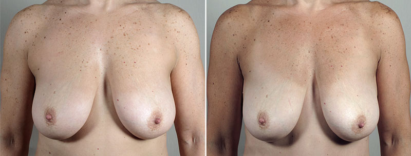 Axillary Breast Liposuction