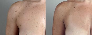 Axillary Breast Liposuction