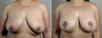 Breast Lift with Augmentation 52