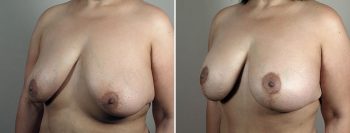 Breast Lift with Augmentation 52