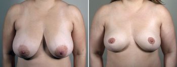 Breast Reduction with Lift 5