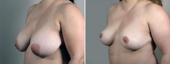 Breast Reduction with Lift 5