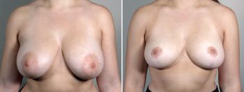 Breast Reduction with Lift 7