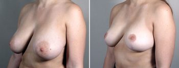 Breast Reduction with Lift 7