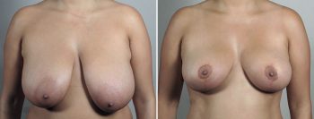 Breast Reduction with Lift 6