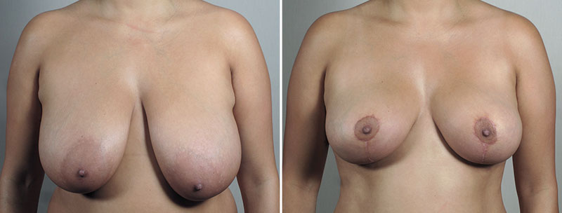 Breast Reduction with Lift 6