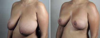 Breast Reduction with Lift 6
