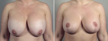 Removal & Replacement of Implants with Tummy Tuck