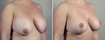 Removal & Replacement of Implants with Tummy Tuck