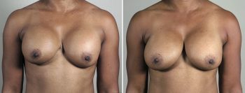 Removal & Replacement of Implants 39