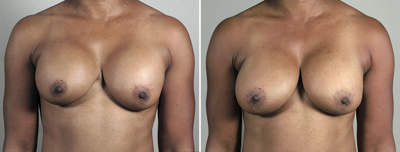 Removal & Replacement of Implants 39