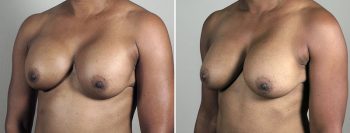 Removal & Replacement of Implants 39