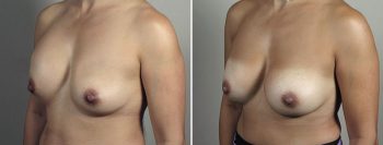 Removal & Replacement of Implants 50