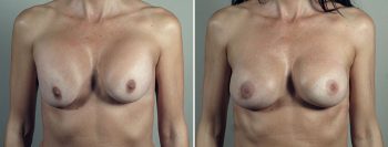 Removal & Replacement of Implants 51