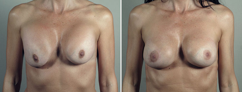 Removal & Replacement of Implants 51