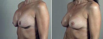 Removal & Replacement of Implants 51