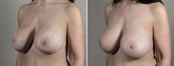 Removal & Replacement of Implants 52