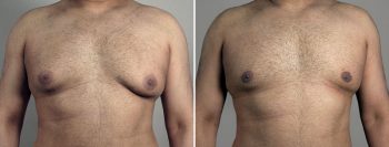 Gynecomastia Reduction Patient 65